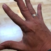 سبب تنميل اليدين